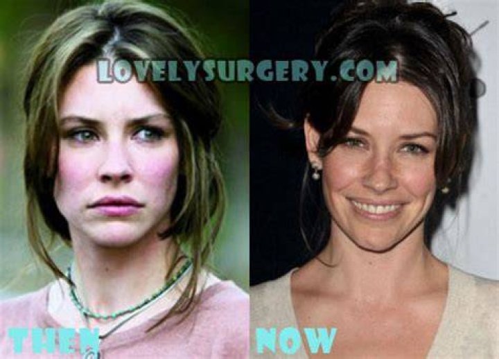 Evangeline Lilly Plastic Surgery Before and After